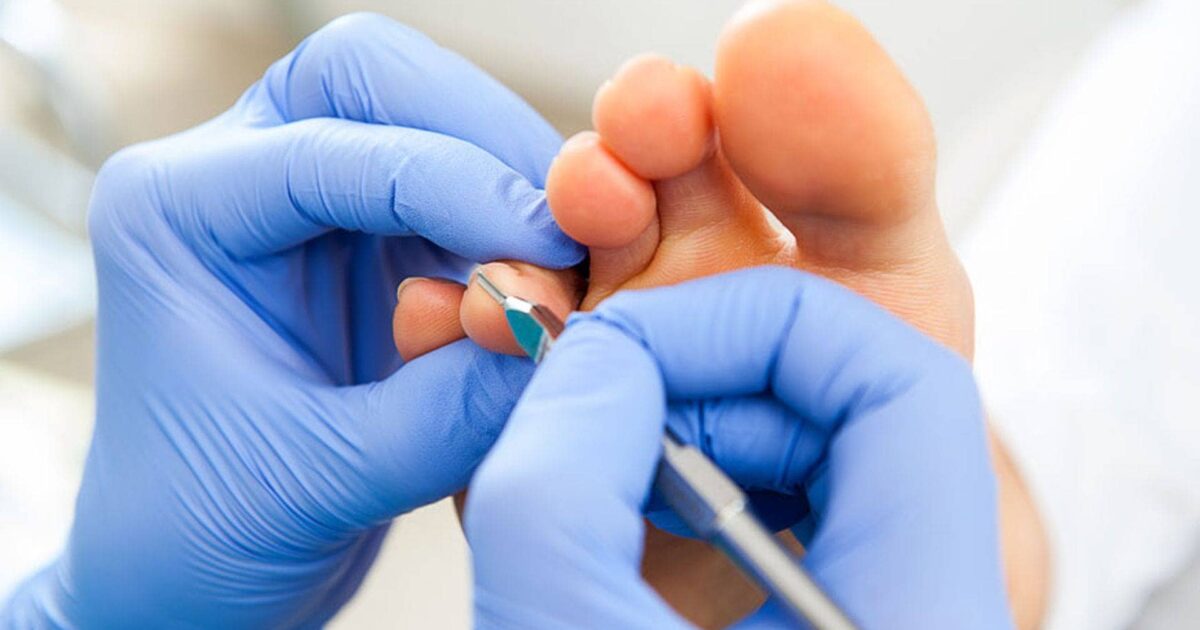 Eliminación de callos sin dolor